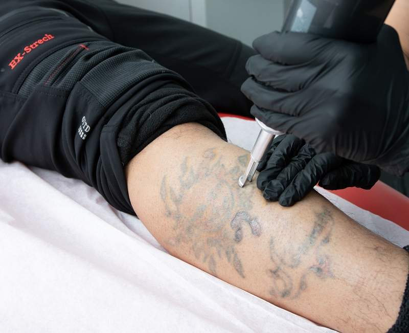 Eliminación de tatuaje