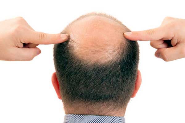 La alopecia es la pérdida anormal de cabello